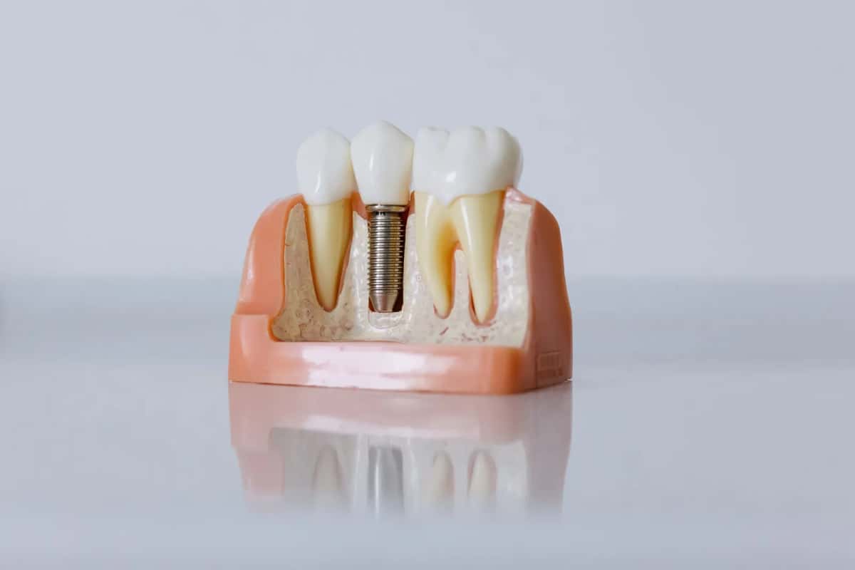 Maquette pédagogique d'un implant dentaire en coupe, entre deux dents