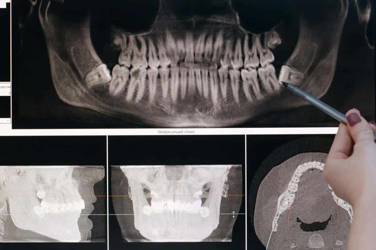 Radiographie panoramique dentaire affichée sur un écran, montrée au stylo par un praticien